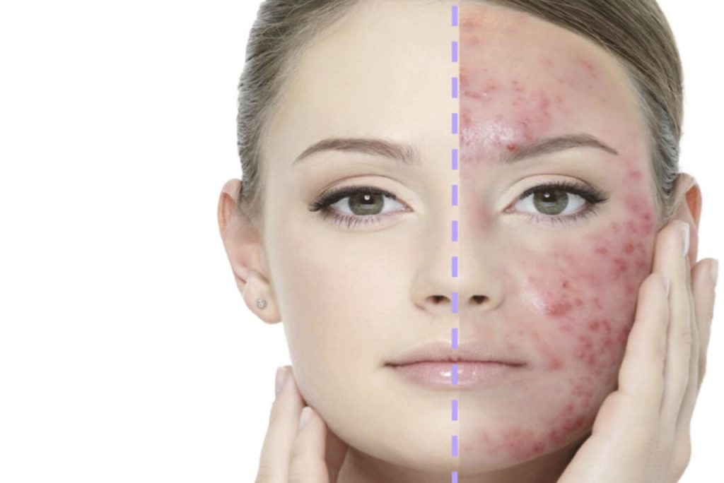 Acneborttagning, hur man får bort acne och finnar